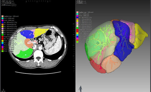 Phần mềm XP Liver : Training 3D Cutting Video